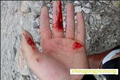 梦见手流血